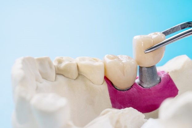 dental crowns