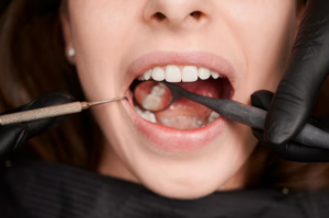 Addressing damaged restorations