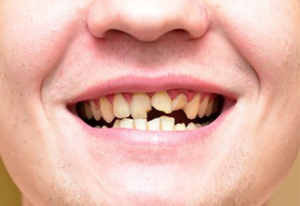 cracked or broken tooth